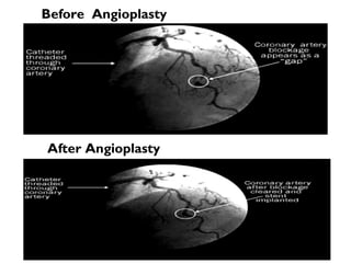 Before  Angioplasty After Angioplasty 
