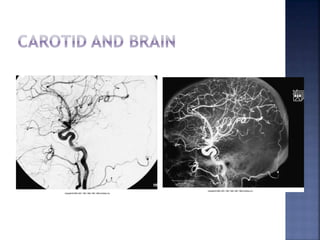 Angiography | PPTX