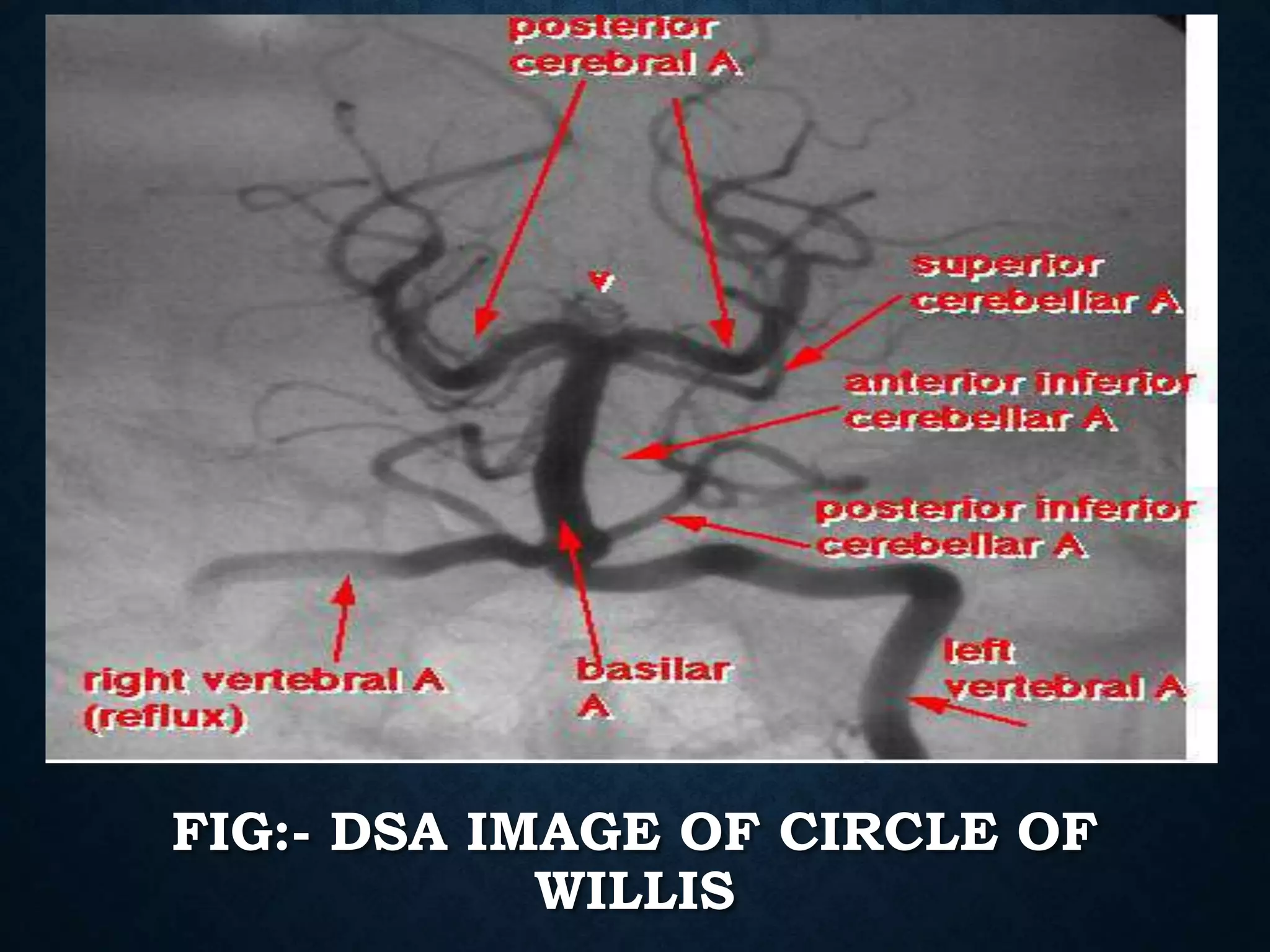 Angiography of Head and Neck | PPTX