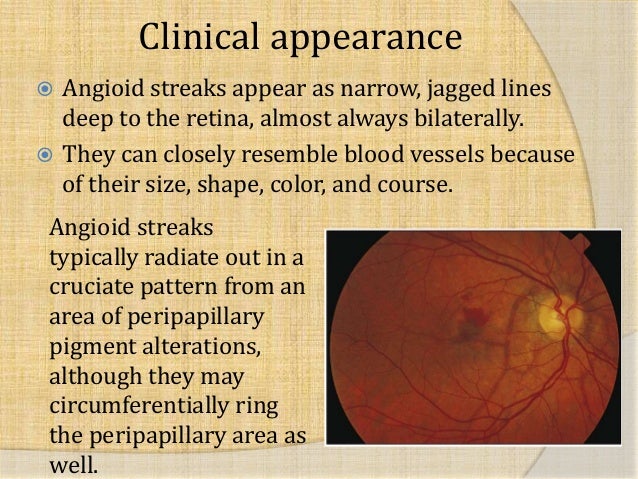 All Cases Of Angioid Streaks Studied Histopathologically Have Shown Identical Changes Despite Different Underlying Systemic Diseases 7 All Cases Of Angioid Streaks Studied Histopathologically Have Shown Identical Changes Despite Different Underlying Systemic Diseases 7