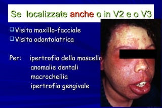 Se localizzate anche o in V2 e o V3
 Visita maxillo-facciale
 Visita odontoiatrica


Per:   ipertrofia della mascella
  ...