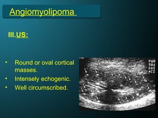 Angiomyolipoma
III.US:
• Round or oval cortical
masses.
• Intensely echogenic.
• Well circumscribed.
 