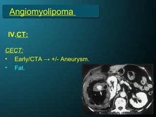 Angiomyolipoma
IV.CT:
CECT:
• Early/CTA → +/- Aneurysm.
• Fat.
 