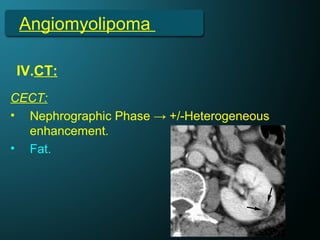 Angiomyolipoma
IV.CT:
CECT:
• Nephrographic Phase → +/-Heterogeneous
enhancement.
• Fat.
 