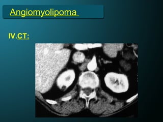 Angiomyolipoma
IV.CT:
 