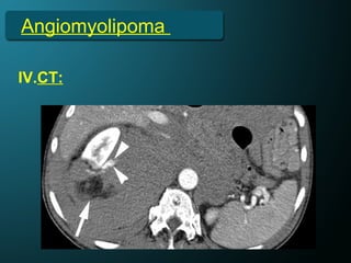 Angiomyolipoma
IV.CT:
 