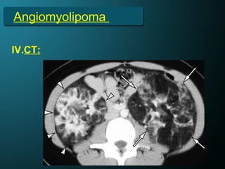 Angiomyolipoma
IV.CT:
 
