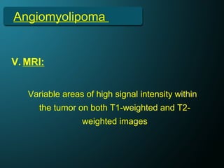 Angiomyolipoma
V. MRI:
Variable areas of high signal intensity within
the tumor on both T1-weighted and T2-
weighted images
 