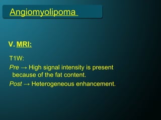 Angiomyolipoma
V. MRI:
T1W:
Pre → High signal intensity is present
because of the fat content.
Post → Heterogeneous enhancement.
 