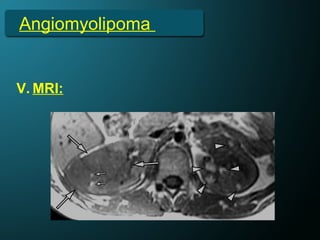 Angiomyolipoma
V. MRI:
 