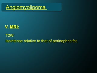 Angiomyolipoma
V. MRI:
T2W:
Isointense relative to that of perinephric fat.
 