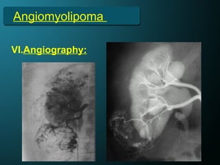 Angiomyolipoma
VI.Angiography:
 