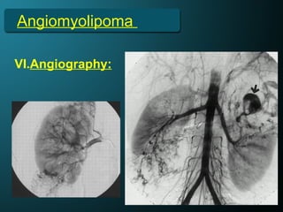 Angiomyolipoma
VI.Angiography:
 