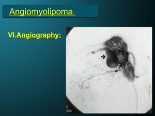 Angiomyolipoma
VI.Angiography:
 
