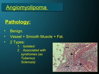 Angiomyolipoma
• Benign.
• Vessel + Smooth Muscle + Fat.
• 2 Types:
Pathology:
1. Isolated.
2. Associated with
syndromes (as
Tuberous
Sclerosis)
 