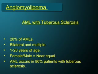 Angiomyolipoma
• 20% of AMLs.
• Bilateral and multiple.
• 1-20 years of age.
• Female/Male = Near equal.
• AML occurs in 80% patients with tuberous
sclerosis.
AML with Tuberous Sclerosis
 