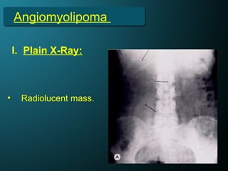 Angiomyolipoma
I. Plain X-Ray:
• Radiolucent mass.
 