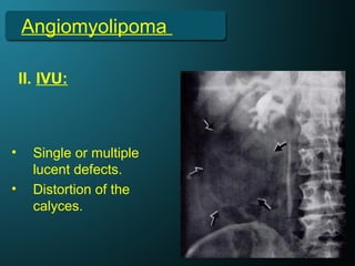 Angiomyolipoma
II. IVU:
• Single or multiple
lucent defects.
• Distortion of the
calyces.
 