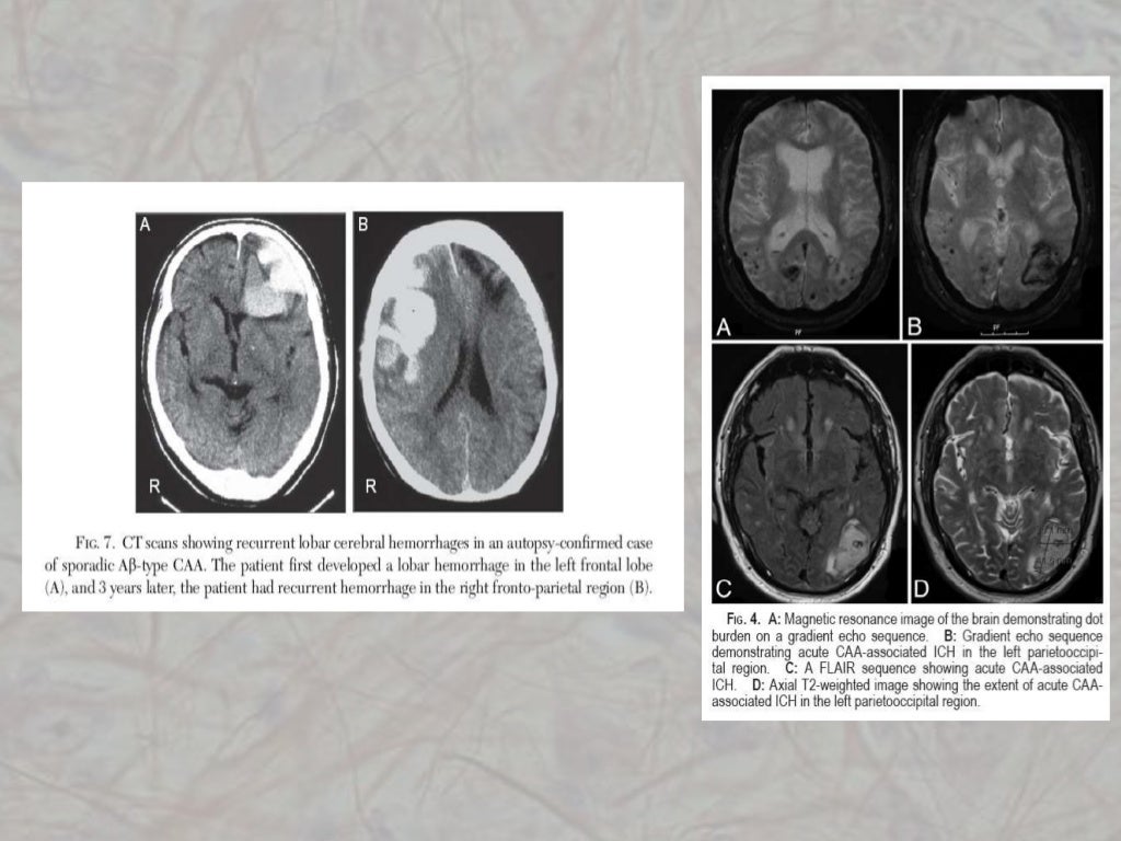 Angiopatia amiloide cerebral.