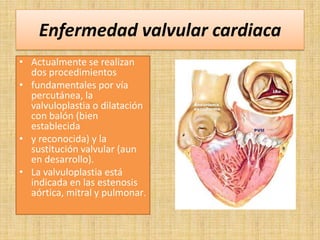 Enfermedad valvular cardiaca
• Actualmente se realizan
dos procedimientos
• fundamentales por vía
percutánea, la
valvuloplastia o dilatación
con balón (bien
establecida
• y reconocida) y la
sustitución valvular (aun
en desarrollo).
• La valvuloplastia está
indicada en las estenosis
aórtica, mitral y pulmonar.

 
