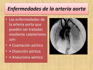 Enfermedades de la arteria aorta
• Las enfermedades de
la arteria aorta que
pueden ser tratadas
mediante cateterismo
son:
• • Coartación aórtica
• • Disección aórtica
• • Aneurisma aórtico

 