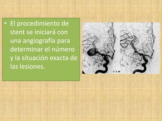 • El procedimiento de
stent se iniciará con
una angiografía para
determinar el número
y la situación exacta de
las lesiones.

 