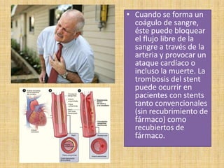 • Cuando se forma un
coágulo de sangre,
éste puede bloquear
el flujo libre de la
sangre a través de la
arteria y provocar un
ataque cardíaco o
incluso la muerte. La
trombosis del stent
puede ocurrir en
pacientes con stents
tanto convencionales
(sin recubrimiento de
fármaco) como
recubiertos de
fármaco.

 