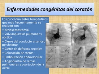 Enfermedades congénitas del corazón
Los procedimientos terapéuticos
que más frecuentemente se
realizan son :
• Atrioseptostomía
• Valvuloplastias pulmonar y
aórtica
• Cierre del conducto arterioso
persistente
• Cierre de defectos septales
• Colocación de stents
• Embolización endovascular
• Angioplastia de ramas
pulmonares y coartación de la
aorta

 