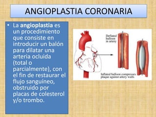 ANGIOPLASTIA CORONARIA
• La angioplastia es
un procedimiento
que consiste en
introducir un balón
para dilatar una
arteria ocluida
(total o
parcialmente), con
el fin de restaurar el
flujo sanguíneo,
obstruido por
placas de colesterol
y/o trombo.

 