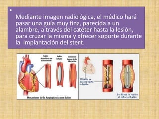 •

Mediante imagen radiológica, el médico hará
pasar una guía muy fina, parecida a un
alambre, a través del catéter hasta la lesión,
para cruzar la misma y ofrecer soporte durante
la implantación del stent.

 