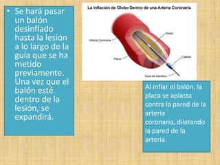 • Se hará pasar
un balón
desinflado
hasta la lesión
a lo largo de la
guía que se ha
metido
previamente.
Una vez que el
balón esté
dentro de la
lesión, se
expandirá.

Al inflar el balón, la
placa se aplasta
contra la pared de la
arteria
coronaria, dilatando
la pared de la
arteria.

 