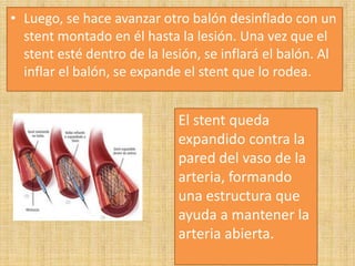 • Luego, se hace avanzar otro balón desinflado con un
stent montado en él hasta la lesión. Una vez que el
stent esté dentro de la lesión, se inflará el balón. Al
inflar el balón, se expande el stent que lo rodea.

El stent queda
expandido contra la
pared del vaso de la
arteria, formando
una estructura que
ayuda a mantener la
arteria abierta.

 