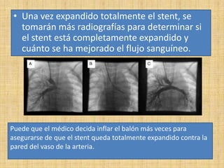 • Una vez expandido totalmente el stent, se
tomarán más radiografías para determinar si
el stent está completamente expandido y
cuánto se ha mejorado el flujo sanguíneo.

Puede que el médico decida inflar el balón más veces para
asegurarse de que el stent queda totalmente expandido contra la
pared del vaso de la arteria.

 