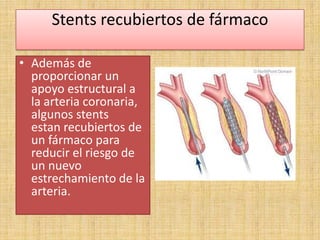 Stents recubiertos de fármaco
• Además de
proporcionar un
apoyo estructural a
la arteria coronaria,
algunos stents
estan recubiertos de
un fármaco para
reducir el riesgo de
un nuevo
estrechamiento de la
arteria.

 