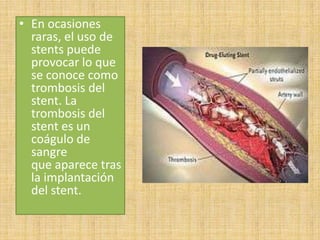 • En ocasiones
raras, el uso de
stents puede
provocar lo que
se conoce como
trombosis del
stent. La
trombosis del
stent es un
coágulo de
sangre
que aparece tras
la implantación
del stent.

 