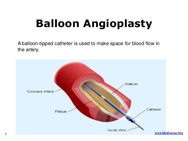 facts on angioplasty