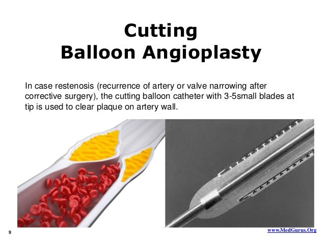 facts on angioplasty