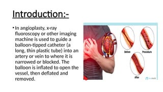 ANGIOPLASTY procedure a minimal invasive procedure ppt..pptx