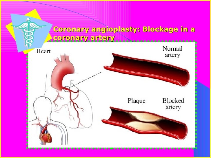Open heart surgery vs stents