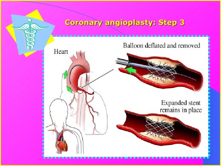 Angioplasty Vs. Bypass