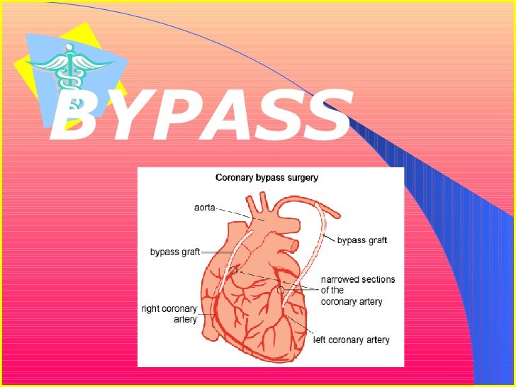 Angioplasty Vs. Bypass