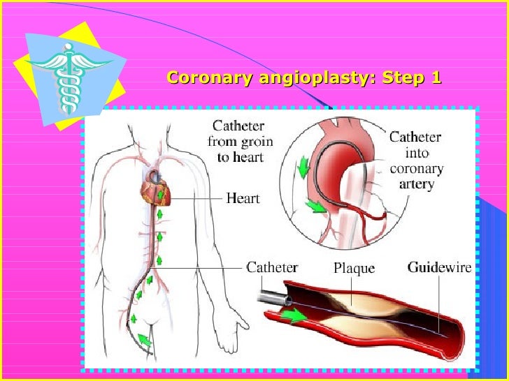 Angioplasty Vs. Bypass