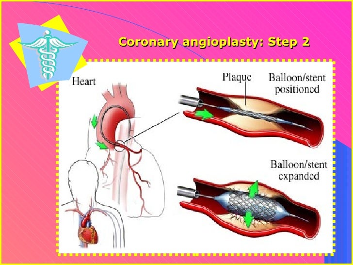 Angioplasty Vs. Bypass