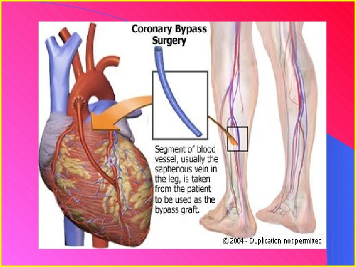 Angioplasty Vs. Bypass