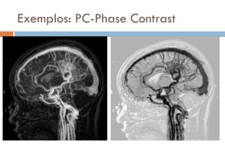 Exemplos: PC-Phase Contrast
 