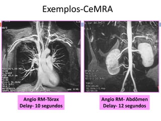 Exemplos-CeMRA
Angio RM-Tórax
Delay- 10 segundos
Angio RM- Abdômen
Delay- 12 segundos
 
