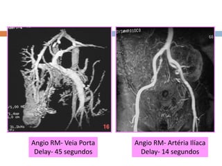 Angio RM- Veia Porta
Delay- 45 segundos
Angio RM- Artéria Ilíaca
Delay- 14 segundos
 