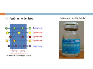 • Fenômeno de fluxo • Uso meios de Contraste
 