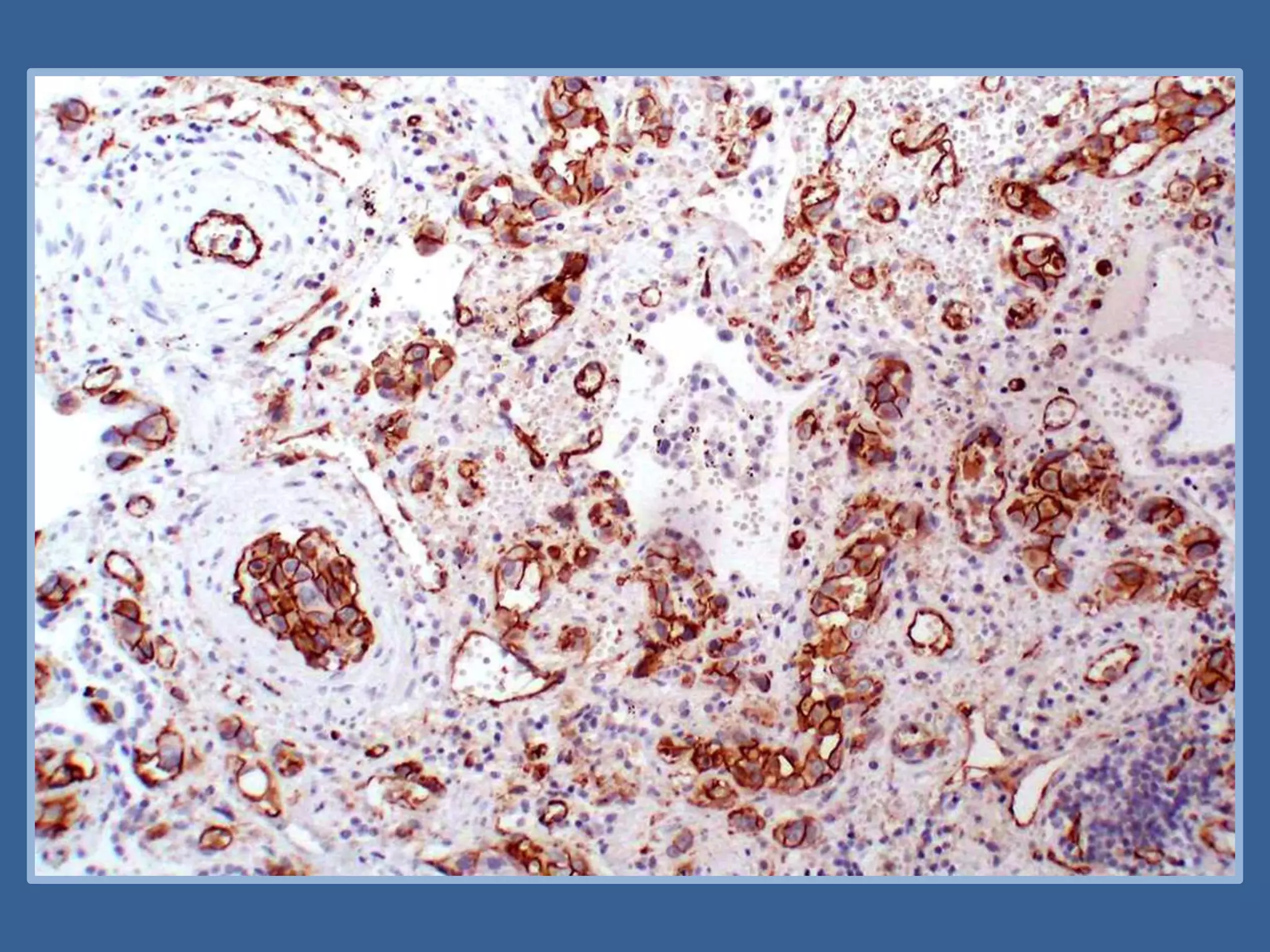 Angiosarcoma | PPTX