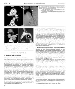 32-214-A-10 Angioscanographie des artères pulmonaires Radiodiagnostic 
*A *B 
*A *B 
PATHOLOGIE CONGÉNITALE 
¦ Anomalies du 6e arc aortique 
Artère pulmonaire gauche aberrante ou rétrotrachéale 
Cette malformation rare est à l’origine d’une compression trachéale 
sévère, parfois associée à des malformations cardiaques et 
extracardiaques [9]. Cette anomalie est parfois rapportée dans la 
population adulte, le plus souvent chez des patients 
asymptomatiques ou présentant une dysphagie par dilatation 
athéromateuse du vaisseau anormal [50]. Le scanner en fait aisément 
le diagnostic (fig 22), et montre la naissance de l’artère pulmonaire 
gauche au niveau soit de l’artère pulmonaire droite soit de la partie 
moyenne du tronc de l’artère pulmonaire. Elle passe ensuite le long 
du bord droit de la trachée et se dirige, entre la trachée et 
l’oesophage, vers le poumon gauche responsable d’une compression 
du bord postérieur de la trachée et de l’origine de la bronche souche 
droite [2]. L’origine anormale de cette artère pulmonaire gauche est 
bien identifiée sur les coupes axiales, et les reformations MPR et 3D 
notamment SSD permettent une vue d’ensemble des rapports de 
l’arbre trachéobronchique et des structures vasculaires. Ces 
reformations sont également performantes pour démontrer la 
sténose trachéale et les anomalies trachéobronchiques associées. 
Le scanner permet aussi de détecter une atélectasie ou un 
emphysème obstructif du poumon droit en rapport avec la 
compression de la bronche souche droite. 
21 Envahissement de l’artère lobaire inférieure gauche par un cancer bron-chopulmonaire 
proximal chez un homme de 57 ans. Angioscanographie en 
coupe de 3 mm (A) et angiographie pulmonaire (B). 
A. L’artère lobaire inférieure apparaît engainée par le processus tumo-ral 
responsable d’un faux anévrisme. 
B. Confirmation par angiographie pulmonaire réalisée au décours d’une 
hémoptysie sévère. 
« Absence » unilatérale d’une artère pulmonaire 
Cette anomalie peut être isolée ou associée à différentes 
cardiopathies congénitales, en particulier la tétralogie de Fallot. Elle 
atteint plus souvent le poumon droit que le poumon gauche [26]. 
Lorsqu’elle est isolée, son diagnostic peut être porté chez l’adulte 
car il s’agit d’une malformation le plus souvent asymptomatique. 
L’angioscanner spiralé montre un tronc artériel pulmonaire normal, 
mais l’absence de branche artérielle pulmonaire du côté atteint. La 
circulation pulmonaire est assurée de ce côté par plusieurs vaisseaux 
systémiques d’origine aortique qui proviennent de l’artère sous-clavière, 
des artères bronchiques et de l’aorte abdominale. Le 
poumon homolatéral est hypoplasique et une hypertrophie 
compensatrice de l’autre poumon entraîne une hernie 
transmédiastinale antérieure et un déplacement médiastinal vers le 
côté atteint. Le pronostic est en général favorable avec cependant un 
risque d’HTAP et d’hémoptysie [9]. 
¦ Malformations artérioveineuses pulmonaires (MAVP) 
La plupart des MAVP sont congénitales, se présentant soit sous 
forme isolée, soit par des localisations pulmonaires multiples, le plus 
souvent dans le cadre d’une angiodysplasie multiviscérale ou 
maladie de Rendu-Osler [20]. Mais un petit nombre de ces MAVP sont 
acquises, observées au cours d’HTAP, de certaines hépatopathies 
chroniques, post-traumatiques, après une intervention chirurgicale 
ou lors de métastases pulmonaires de cancer de la thyroïde. En 
fonction de leur nombre et de leur taille, elles peuvent être 
responsables d’un shunt gauche-droite. 
L’acquisition de tout le volume thoracique au cours d’une même 
acquisition permet au scanner spiralé d’être la technique de choix 
dans la détection et l’étude de l’angioarchitecture de ces 
malformations. En pratique, deux situations doivent être envisagées. 
Détection 
Une acquisition sans injection de produit de contraste suffit en règle 
générale à la détection de ces malformations, notamment dans la 
fratrie d’un patient porteur d’une angiodysplasie familiale. La 
totalité du thorax doit être explorée au mieux avec des coupes de 2 
à 3 mm d’épaisseur, voire plus fines. Le diagnostic repose sur la mise 
en évidence d’artère(s) afférente(s) et de veine(s) de drainage 
connectées à la malformation. Celle-ci a une forme variable, 
arrondie, ovoïde ou complexe avec plusieurs pédicules nourriciers 
et/ou de drainage. 
Bilan préthérapeutique 
Le scanner avec notamment les reconstructions multiplanaires et 3D, 
SSD ou VRT participe au bilan morphologique préthérapeutique en 
identifiant : 
– le nombre et la topographie exacte de la (ou des) MAVP ; 
22 Artère pulmonaire gauche rétrotrachéale chez un homme de 57 ans asymptoma-tique. 
Angioscanographie en coupe de 3 mm(A) et reconstruction 3D « shaded surface 
display » (SSD) (B). 
A. L’artère pulmonaire gauche naît de l’artère pulmonaire droite et se dirige entre 
la trachée et l’oesophage vers le hile gauche. 
B. La reconstruction 3D SSD montre bien les rapports de l’artère anormale 
(triangle) avec l’axe trachéobronchique. 
12 
 